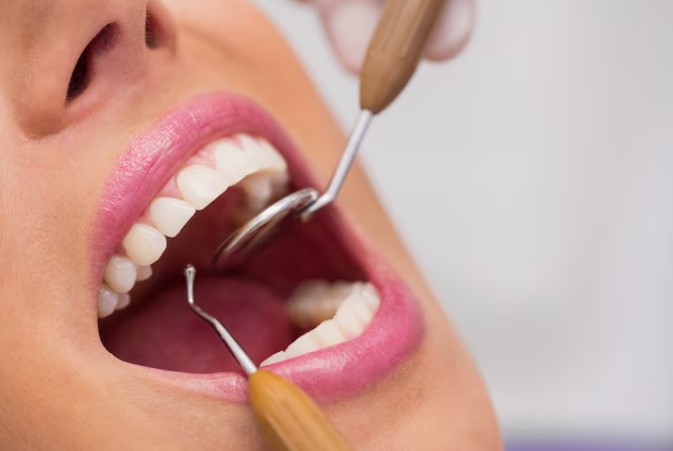 Choosing Porcelain Veneers in Toronto: A Gleaming Transformation